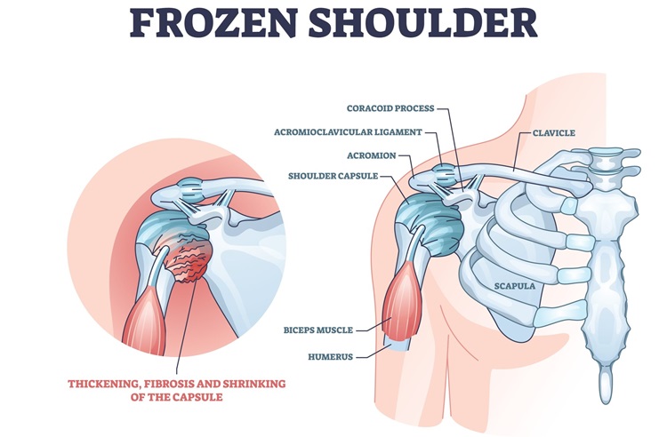 Frozen Shoulder Treatment
