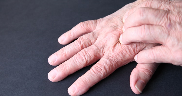 arthritis-treatment-jpg