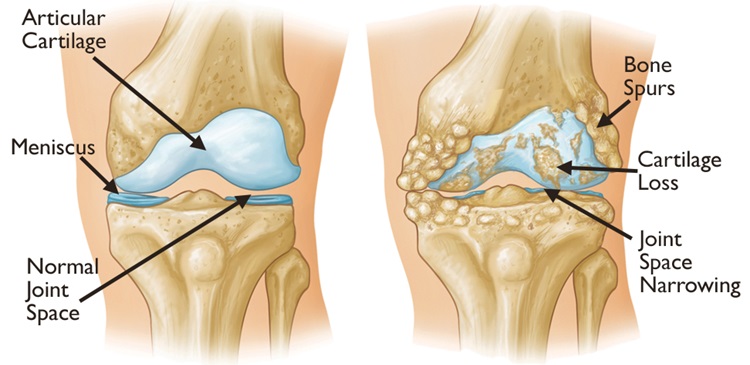 Osteoarthritis Treatment img