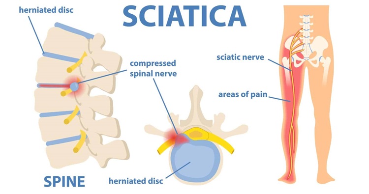 sciatica-treatment-img