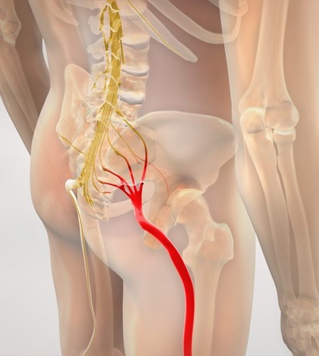 sciatica-pain-img