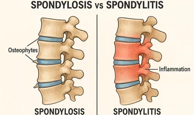spondylitis-treatment-img